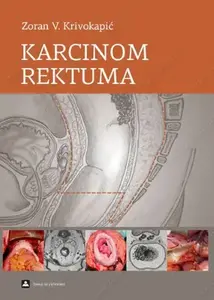 KARCINOM REKTUMA